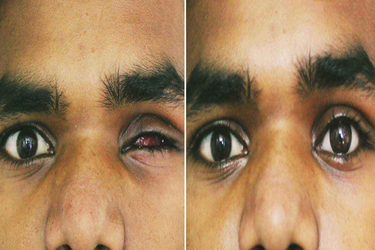 Artificial Eye Surgery