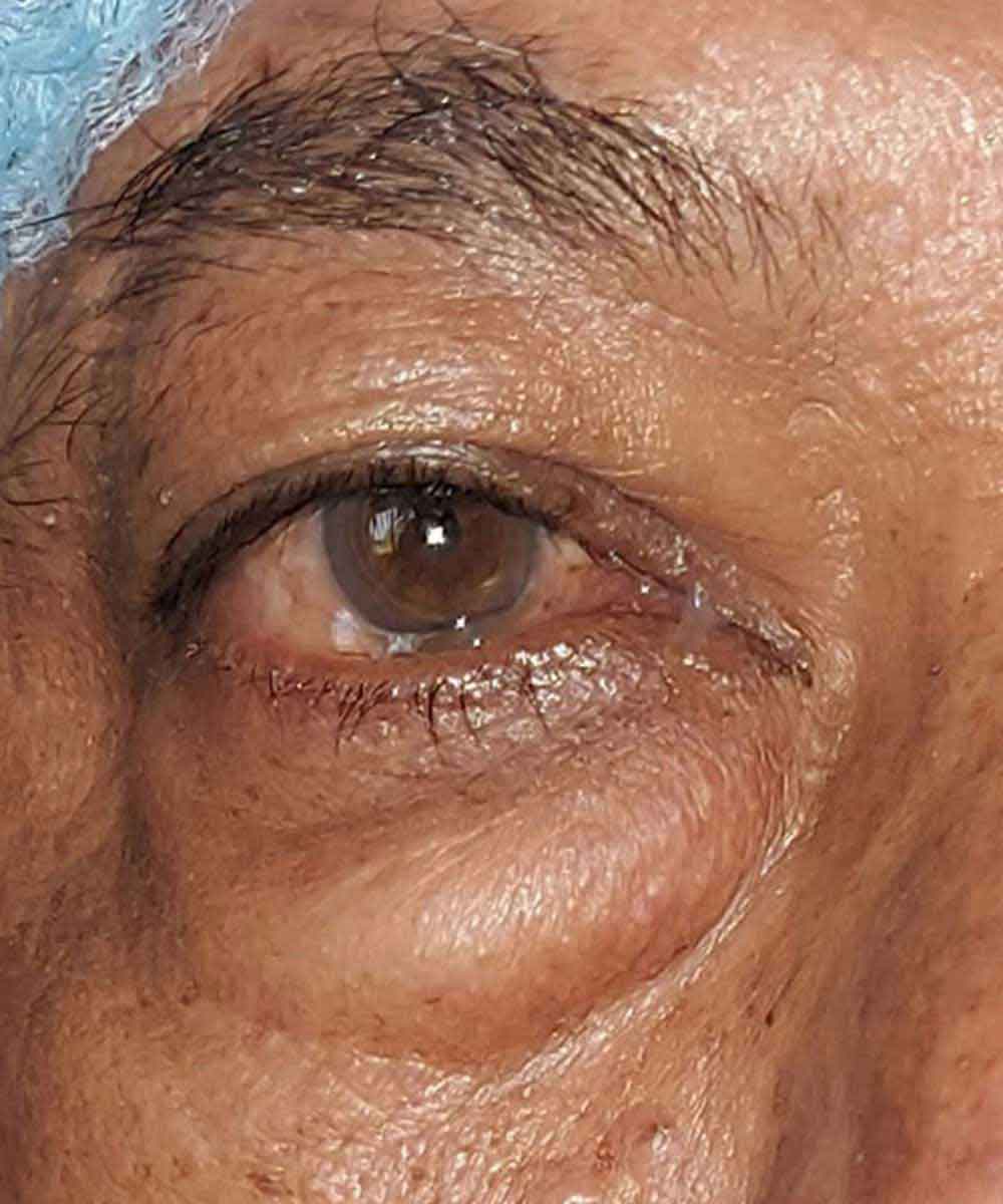 blepharoplasty1
