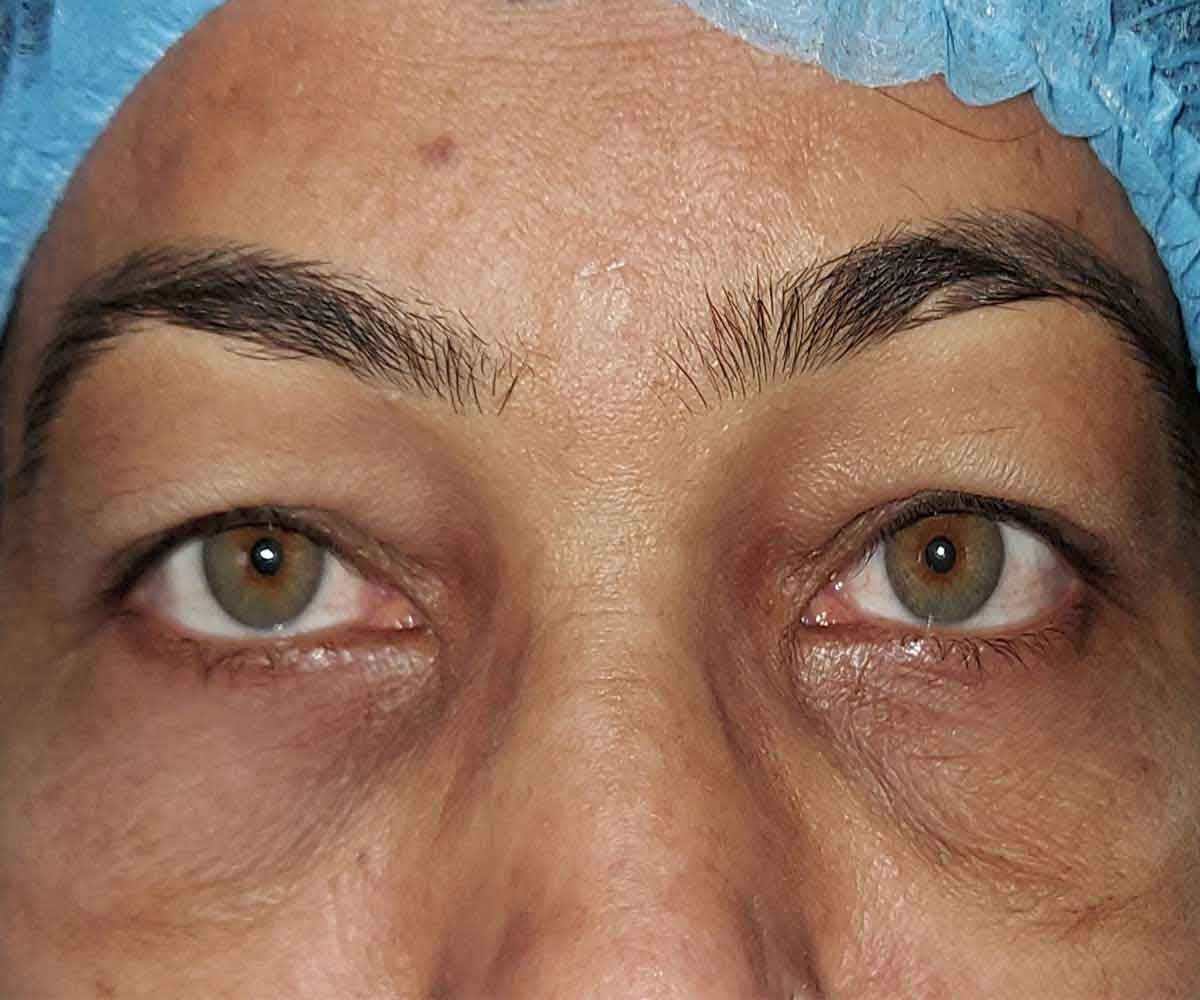 blepharoplasty3
