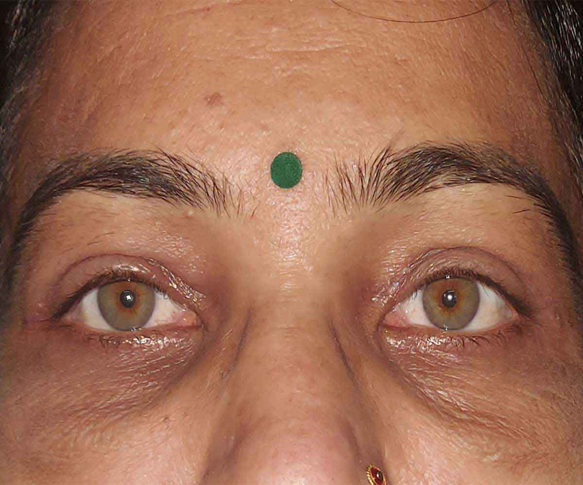 blepharoplasty4