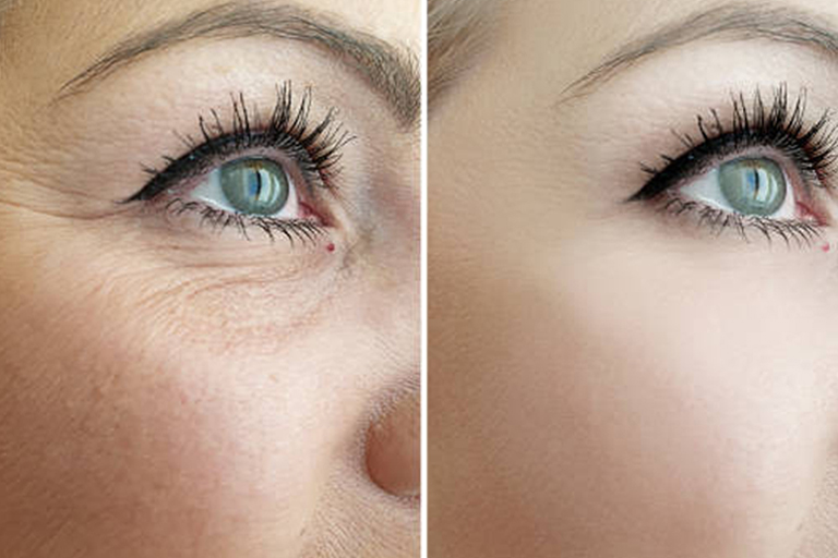 Botox and Fillers Treatment