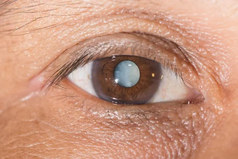 Cataract With Phacoemulsification