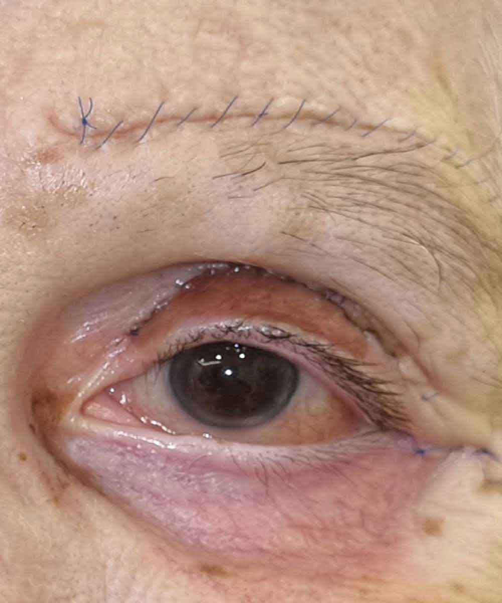 ectropion2