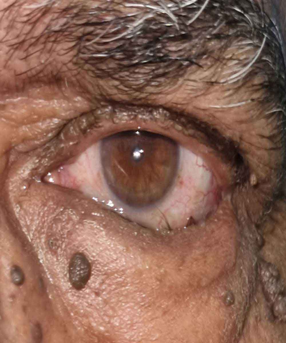 entropion1