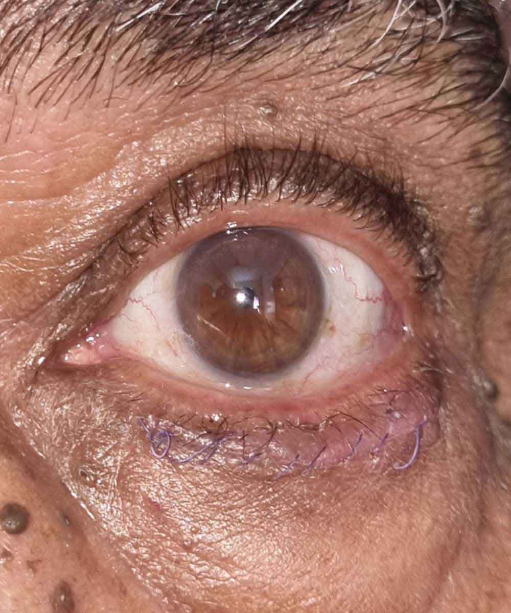 entropion2