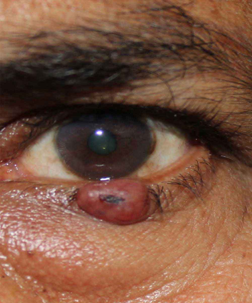 eyelidtumours1