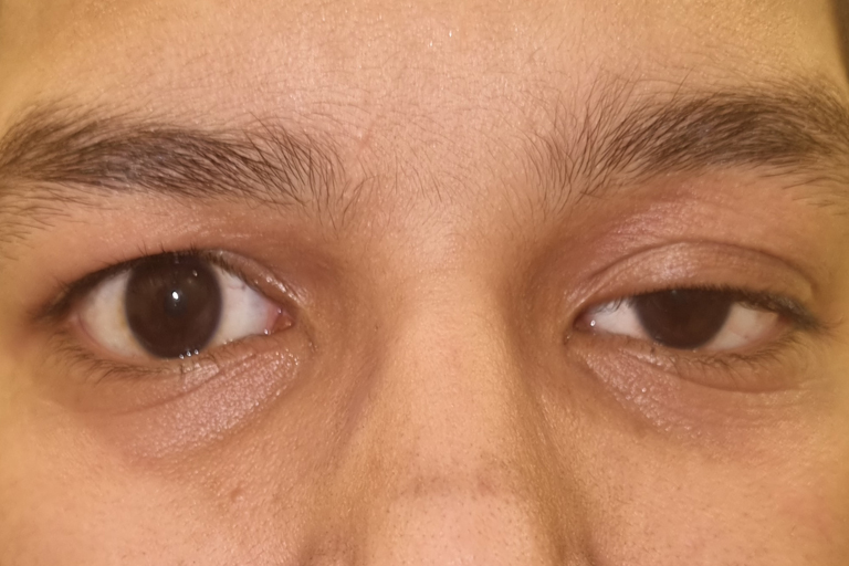 Eyelid Surgeries - Ptosis and Malpositions